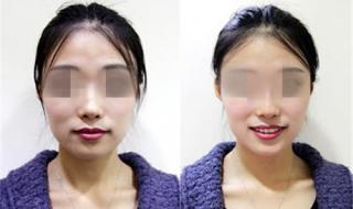 整形鼻子需要多少钱 整形鼻子需要多少钱